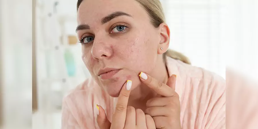 Home Remedies for Pimples: Safe Ways to Calm Acne Breakouts