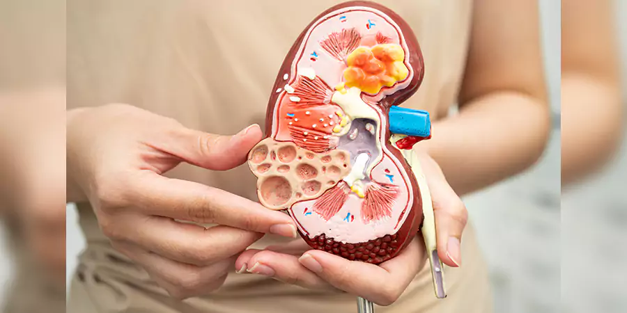 Kidney Stone Symptoms: Warning Signs You Should Know