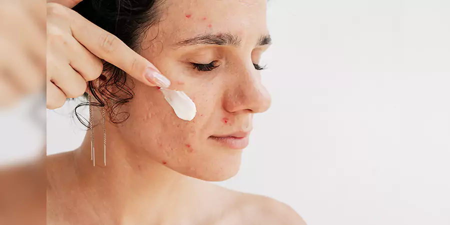 Moisturise acne-prone skin