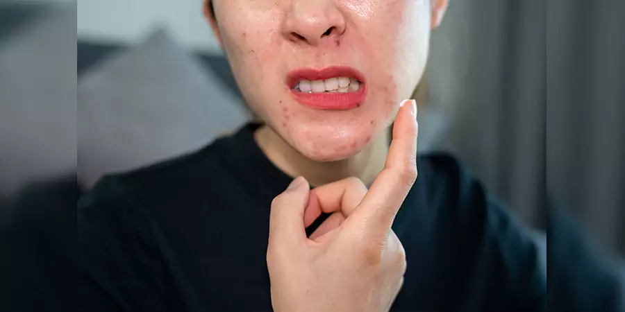 What Causes Pimples