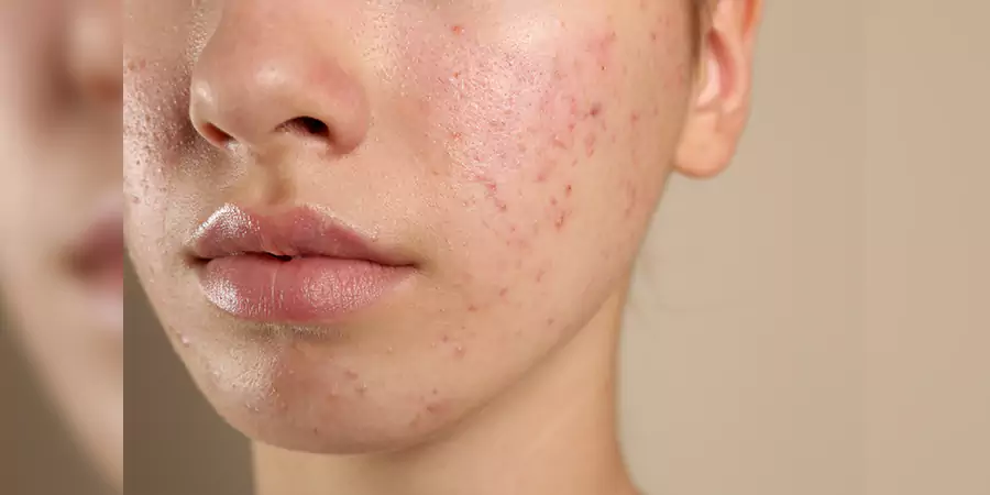 When Should You See a Dermatologist
